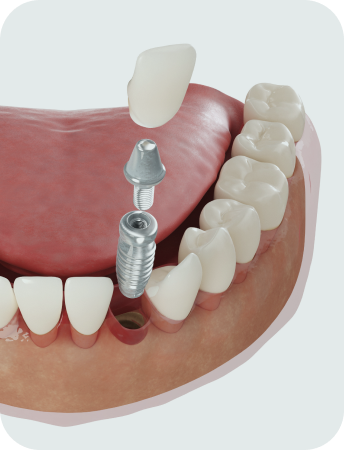 365바른 임플란트